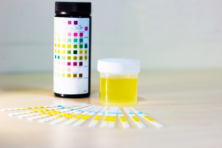 urine sample along with dip stick uristix for analyzing urine glucose protein in diabetesの写真素材