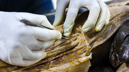 Anatomy dissection of a cadaver showing adductor canal using scalpel scissors and forceps cutting...