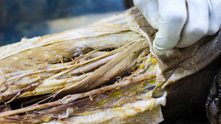 Anatomy dissection of a cadaver showing adductor canal using scalpel scissors and forceps cutting skin flap revealing important structures arteries veins nervesの写真素材