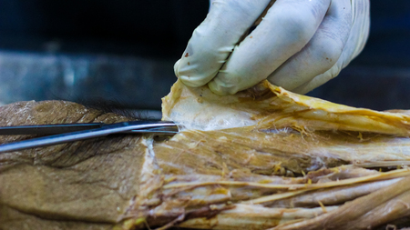Anatomy dissection of a cadaver showing adductor canal using scalpel scissors and forceps cutting...
