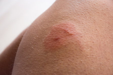 Photo of insect bite on skin. Double  insect bite (bee,wasp,horsefly) with redness, inflammation...
