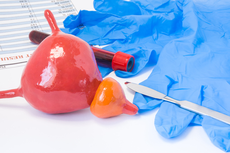 Prostate and urine bladder urology surgery concept. Model of bladder with prostate is near scalpel, surgical gloves and blood test tube with blood result. Indications for surgery or surgical operationの写真素材