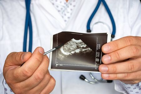 Tumor or other oncology in kidney on ultrasound image concept photo. Doctor indicating by pointer on printed picture ultrasound pathology lesion of kidney tumor. For diagnosis, radiology, nephrologyの写真素材