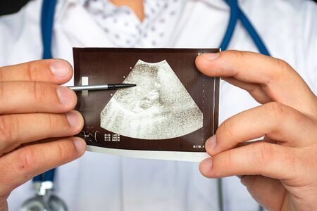 Liver hematoma  on ultrasound image concept photo. Doctor indicating by pointer on printed picture...