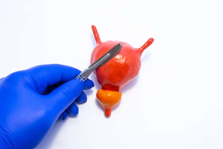 On white background, medical mock-up of bladder with prostate and hand of surgeon in glove with...