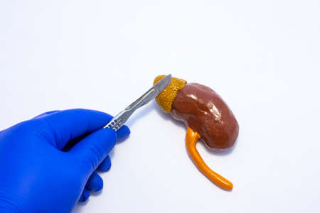 A model of a human kidney with an adrenal gland is on a table, above it is the surgeons hand with a scalpel. Adrenal gland surgery concept photoの写真素材