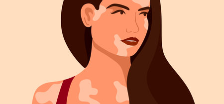 Vitiligo is a young woman with skin problems. Skin diseases. The concept of World Vitiligo Day. Different skin colors of female characters. For a blog, articles, banner, magazine. Vector illustrationのイラスト素材
