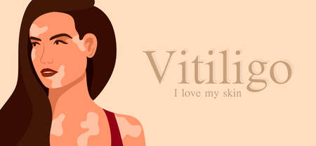 Vitiligo is a young woman with skin problems. Skin diseases. The concept of World Vitiligo Day. Different skin colors of female characters. For a blog, articles, banner, magazine. Vector illustrationのイラスト素材
