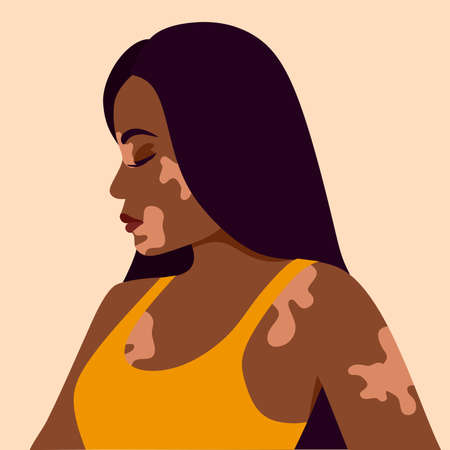 Vitiligo is a young dark-skinned woman with skin problems. Skin diseases. The concept of World Vitiligo Day. Different skin colors of female characters. For a blog, articles, banner, magazine.のイラスト素材