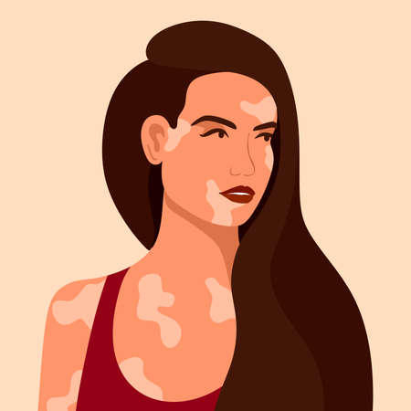 Vitiligo is a young woman with skin problems. Skin diseases. The concept of World Vitiligo Day. Different skin colors of female characters. For a blog, articles, banner, magazine. Vector illustrationのイラスト素材