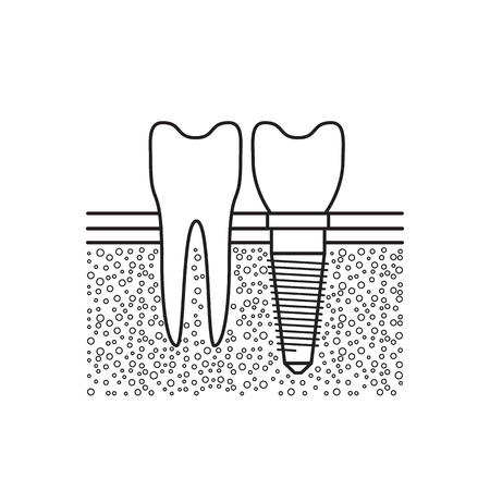 Dental implant located adjacent to a healthy tooth in a patients mouth, vector illustration isolated on white backgroundのイラスト素材