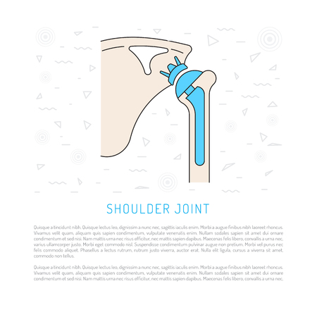 Shoulder prosthesis, vector banner with place for text. Medical illustrationのイラスト素材