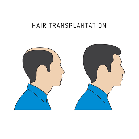 Infographics on the subject of hair transplantation on the example of a man with a picture of the result of transplantation before and after. Vector image of a patient isolated on white backgroundのイラスト素材