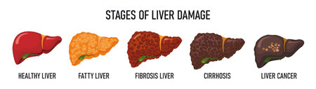 Stages of liver destruction. Medical poster with liver. Set of liver vector illustration on a medical themeのイラスト素材