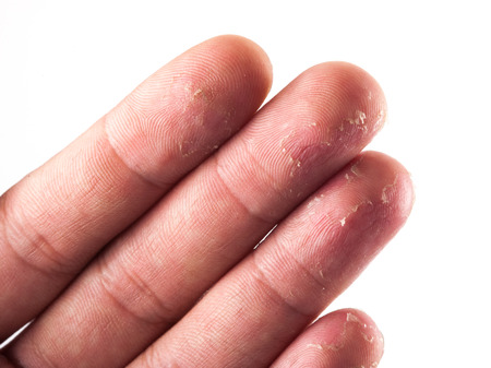 Closeup of Eczema Dermatitis on Back of Fingersの写真素材