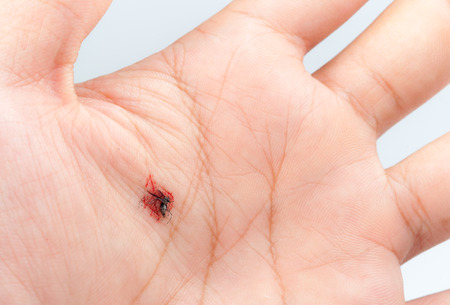 Mosquito with blood deadly hit on palmの写真素材