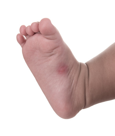 Baby's leg with red spot caused by mosquito bite,Treating itchingの写真素材