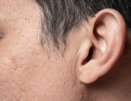 Asian man faceskin problem acne hole and scarの写真素材