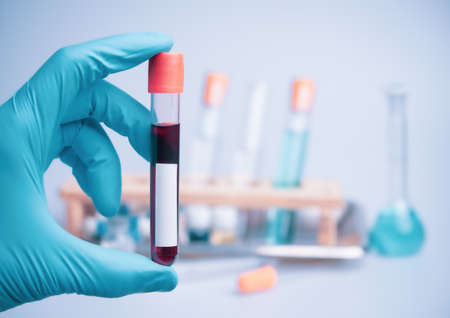 Medical doctor or laborant holding tube with nCoV Coronavirus vaccine for 2019-nCoV COVID virus