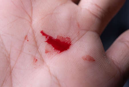 Close up of hand injury with bloodの写真素材