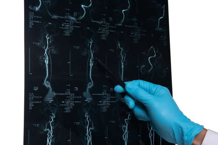 Doctors reviewing brain x-rays;MRI of the blood vessels in the brain and cerebrovascular disease or...