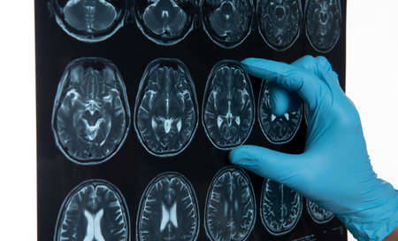 Doctors reviewing brain x-rays;MRI of the blood vessels in the brain and cerebrovascular disease or hemorrhagic stroke.の写真素材