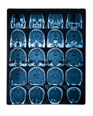 Brain stroke x-ray;MRI of the blood vessels in the brain and cerebrovascular disease or hemorrhagic...