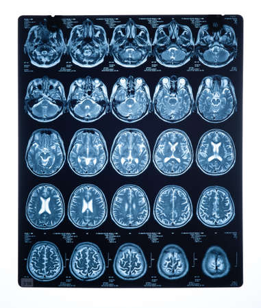 Brain stroke x-ray;MRI of the blood vessels in the brain and cerebrovascular disease or hemorrhagic...