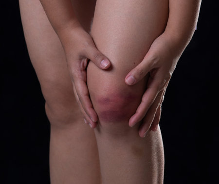 Bruises from blood on woman knee. Injection bruises.の写真素材