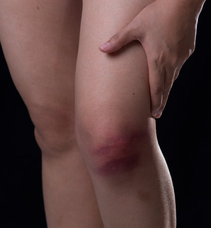 Bruises from blood on woman knee. Injection bruises.の写真素材