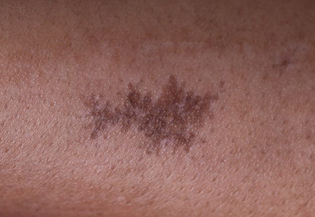 Close up hypertrophic scar at the legの写真素材
