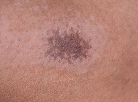 Close up hypertrophic scar at the legの写真素材