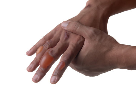 Blister on the hand after a burn isolated on whiteの写真素材