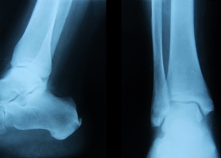 X-ray of human ankle joint. の写真素材