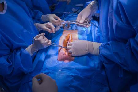 Doctors team wear blue coat perform heart surgery with cadaver at the operating room in the hospital.の写真素材
