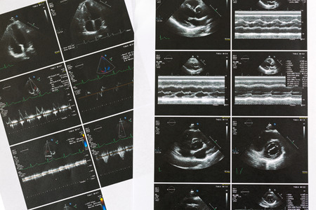Printed set result paper of heart ultrasound scan examination. Echo cardiography examine for irregular heart beats, abnormal rhythm (arrhythmia)の写真素材
