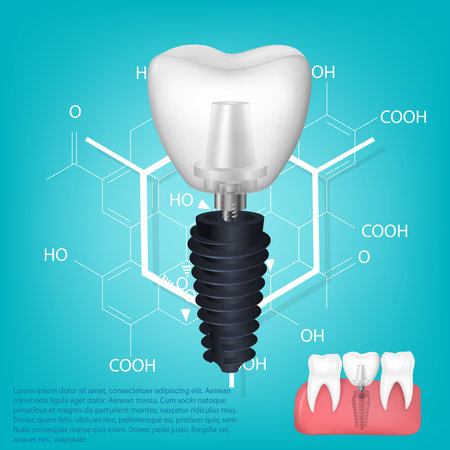 Vector realistic tooth. Structural elements of a dental implant. Infographic for medical poster.のイラスト素材