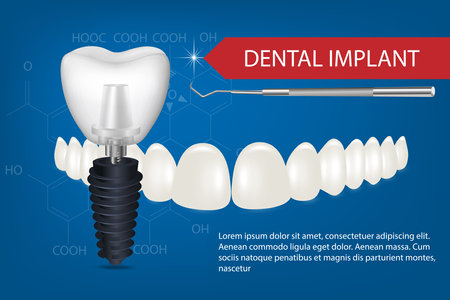 Realistic white dental implant on a blue background with beautiful teeth mockup. Vector 3d model of an implant with thread and inscription.のイラスト素材
