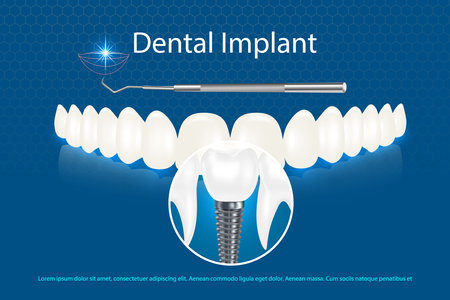 Vector 3d realistic white dental implant on blue background with beautiful teeth mockup. implant model with thread and inscription.のイラスト素材