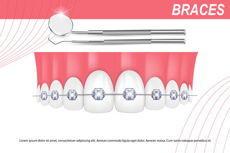 3d vector illustration, realistic teeth with braces upper and lower jaw. Alignment of the bite of teeth, dentition with braces, dental braces.のイラスト素材