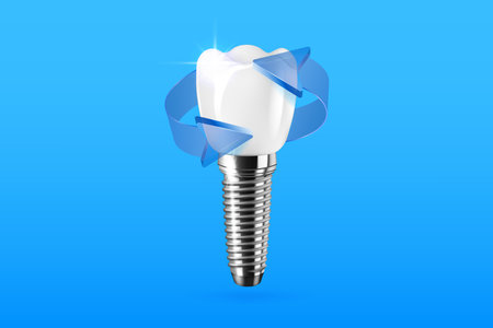 Realistic 3D dental implantation composition with blue arrows. Dental activity illustrationのイラスト素材