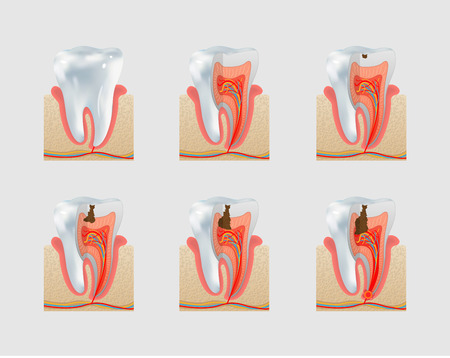 Healthy untreated tooth and dental caries or cavities icon set. Severity of tooth destruction.のイラスト素材