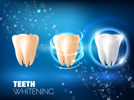 Teeth whitening concept vector realistic illustration. Tooth before whitening, during and after whitening procedure on blue sparkling background. Dental health and teeth restoration ad design template