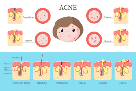 Acne types and formation infographics, vector flat illustrationのイラスト素材