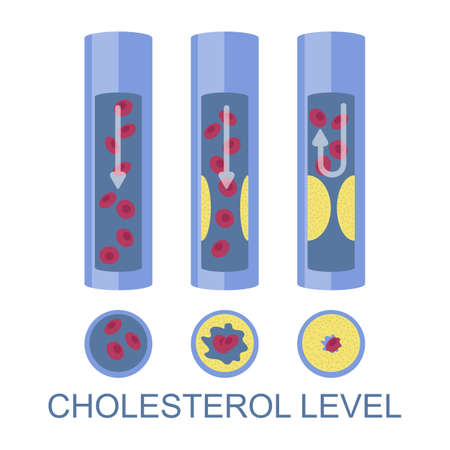 Low, normal, high cholesterol level, vector illustration. High ldl risk factor for heart disease, atherosclerosis.のイラスト素材
