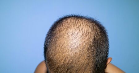a man baldness,middle age man concerned with hair lossの写真素材