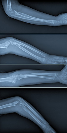 X ray of broken arm with humerus fractureの写真素材