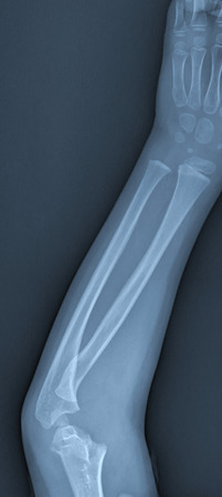 X ray of broken arm with humerus fractureの写真素材