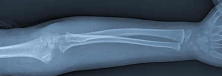X ray of broken arm with humerus fractureの写真素材