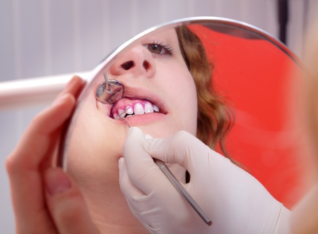 Close up of dental plaque  examine in mirrorの写真素材
